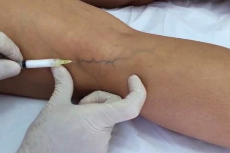 QUE ES LA ESCLEROTERAPIA