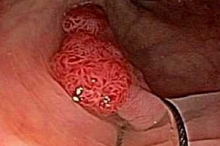 QUE ES UNA POLIPECTOMIA DE COLON