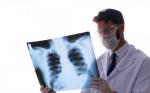 QUE ES UN DERRAME PLEURAL