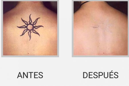 BORRADO DE TATUAJES