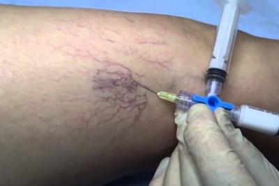 ESCLEROTERAPIA