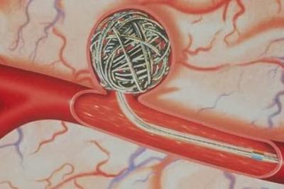 EMBOLIZACION  Y TROMBOSIS