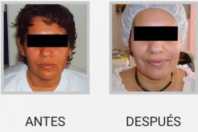 PEELING QUIMICO