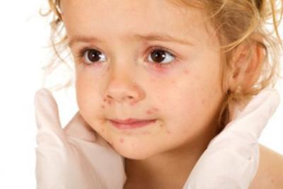 ACNE EN LOS NIÑOS