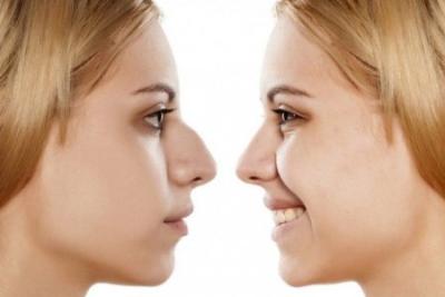 RINOPLASTIA
